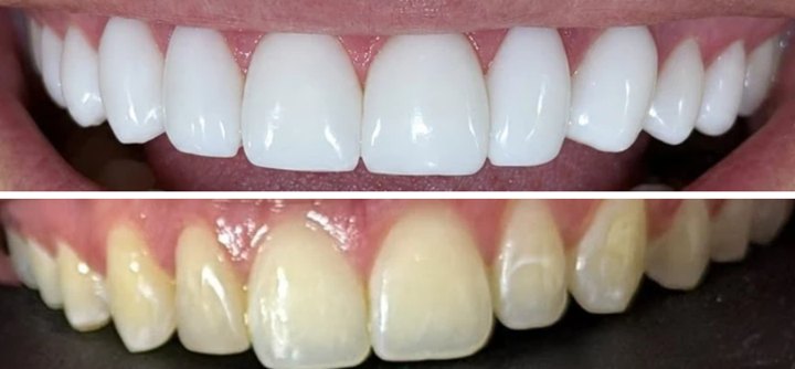 Antes y después de un tratamiento de carillas en Omas Dental O+