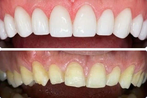 Antes y después de un diseño de sonrisa en Omas Dental O+