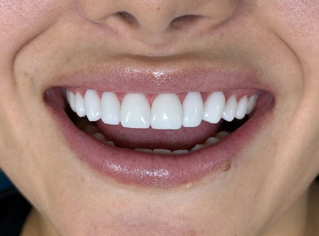 Sonrisa con carillas, resultado de un tratamiento en Omas Dental O+